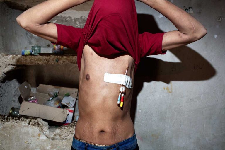 Ghaffar Naghdi is a young Iranian man, aged 24. On his body, he bears the marks of six years of kidney failure that forced him to three dialysis sessions per week. Iran, November 2014.