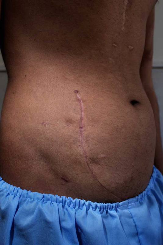 Ghaffarâ??s roommate shows the scar from the operation to remove the kidney he has sold. Iran, November 2014.